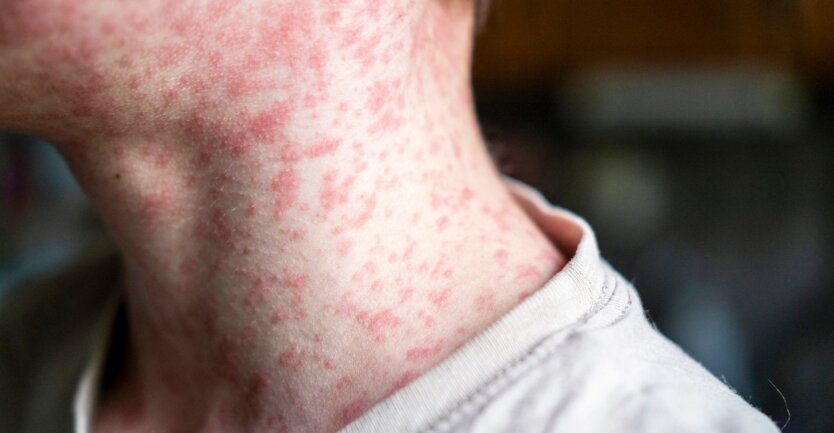Americans Do Not Trust Trump's Administration in Fighting Measles Outbreak - Poll